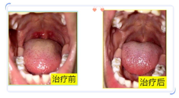 口腔溃疡_20240730152814.jpg