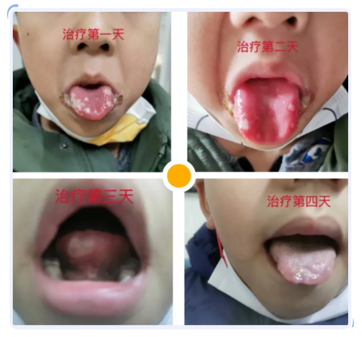 舌尖溃烂_20240730152730.jpg