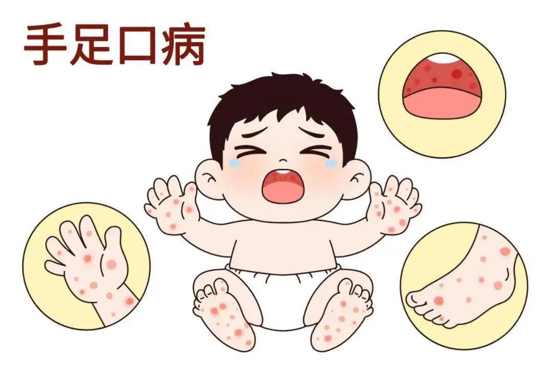 手足口85698769485.jpg